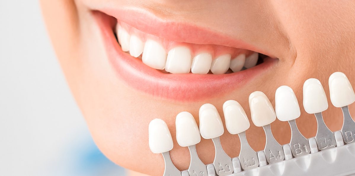 dental veneer result at sage dental
